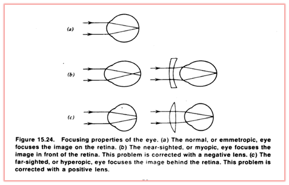 875_Ametropia-Defective eyesight due to focusing 3.png